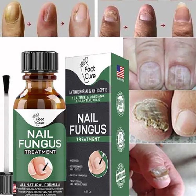 Nail Fungus Treatment Serum – 10ml Anti-Fungal Solution