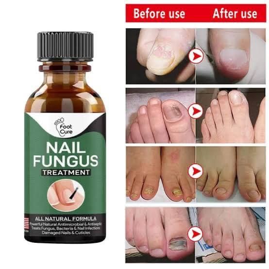 Nail Fungus Treatment Serum – 10ml Anti-Fungal Solution